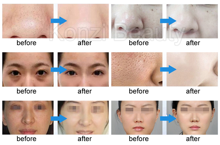 Home Use Strong Vacuum Suction Microdermabrasion Machine Diamond Dermabrasion Face Clean