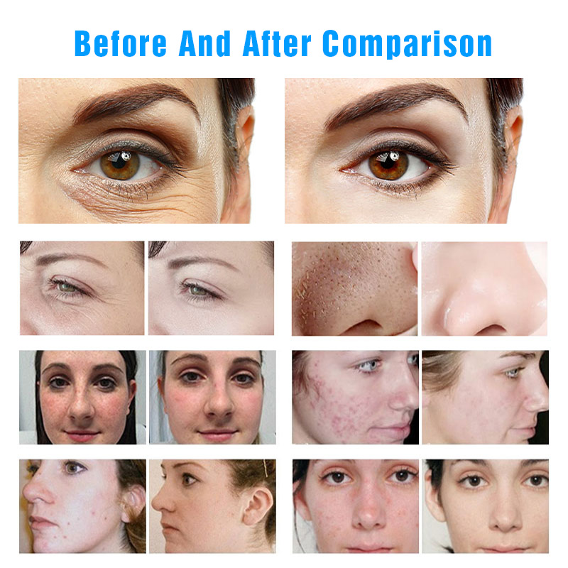 Microdermabrasion Aqua Peeling Machine Blackhead Removal Oxygen Jet Oxygen Facial Dermabrasion Deep Cleaning H2o2 Machine