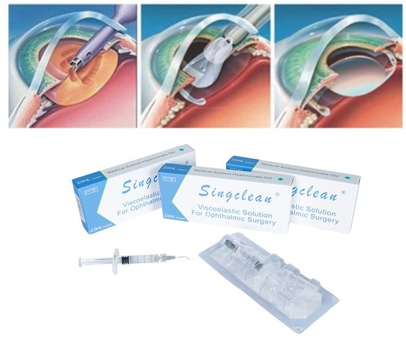 High Purity and Transparency Singclean Sodium Opthalmic Viscosurgical Device in Endothelium Protection
