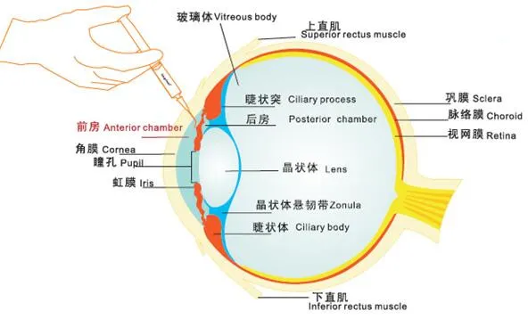 High Purity and Transparency Singclean Sodium Opthalmic Viscosurgical Device in Endothelium Protection