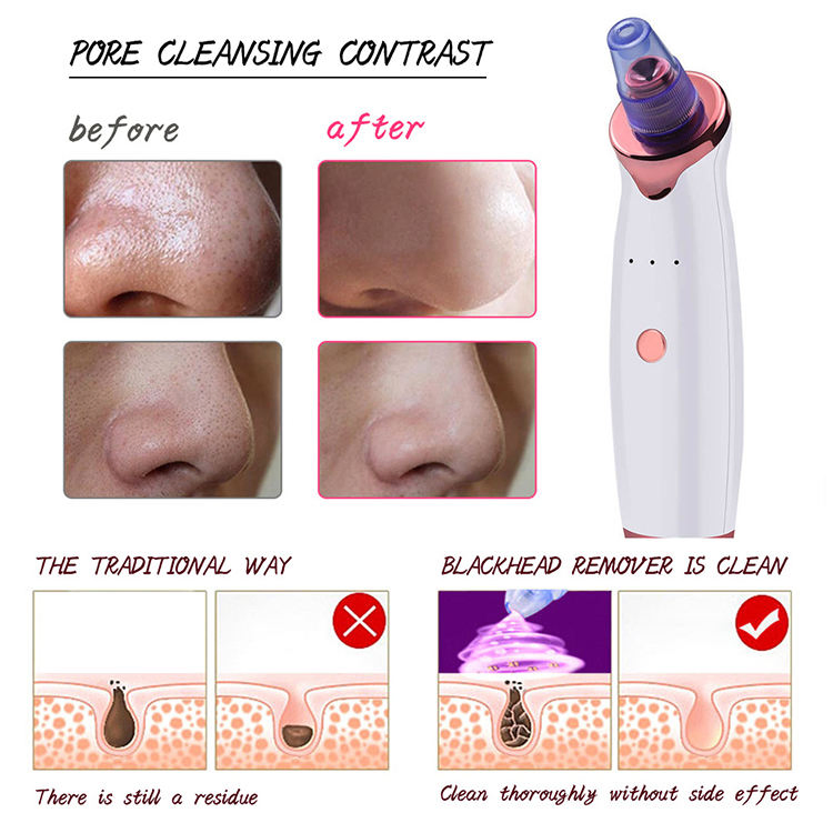 Portable High-Powered Electric Blackhead Remover Device for Cleaning Oil