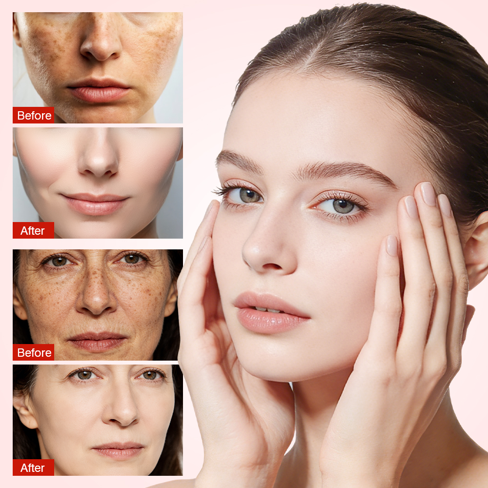 Strong Effective Whitening Freckle Cream Face Remove Melasma Dark Spots Melanin Remover Private Label Brighten Skin Care Cream