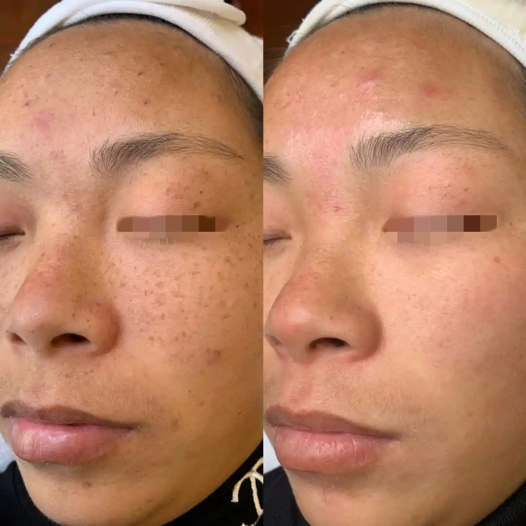 Quita Manchas Cream De Melasma Removes Freckles and Dark Spots Freckle Removing Cream Pigmentation Remover for Face Skin Care