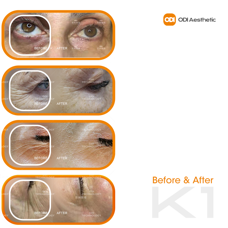 2026 Hot Selling Massage Eye Beauty Device Facial Wrinkles Serum Introduction Remove Eye Bags Dark Circle Removing Eye Wrinkles