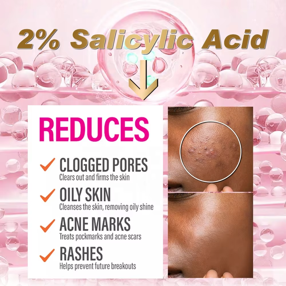 Private Label Face Anti Button Pore Minimizing Oil Control Anti Acne Pimples Remove Salicylic Acid Whitening Cream