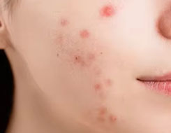 Sensitive Skin