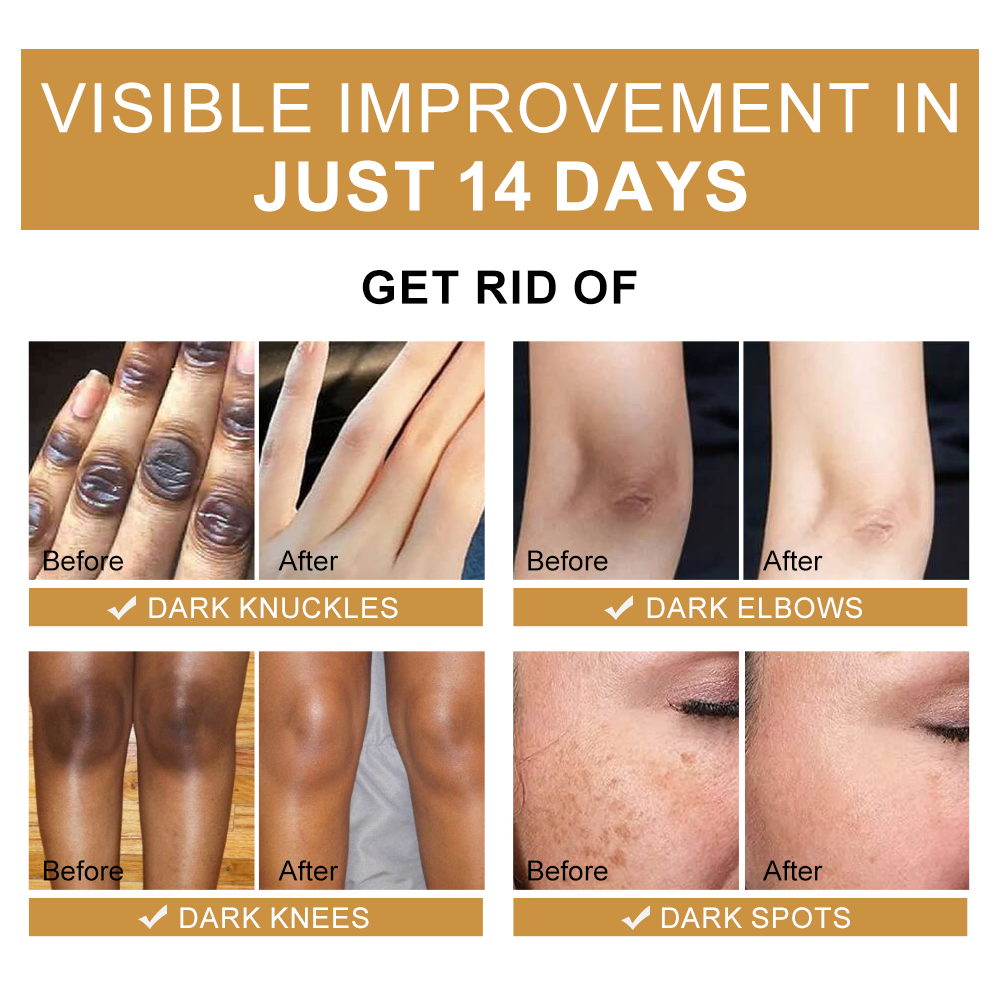Private Label Dark Knuckle Knees Remover Whitening Bleaching Serum Cream Body Lotion Oil Skin Care Set For Dark Skin