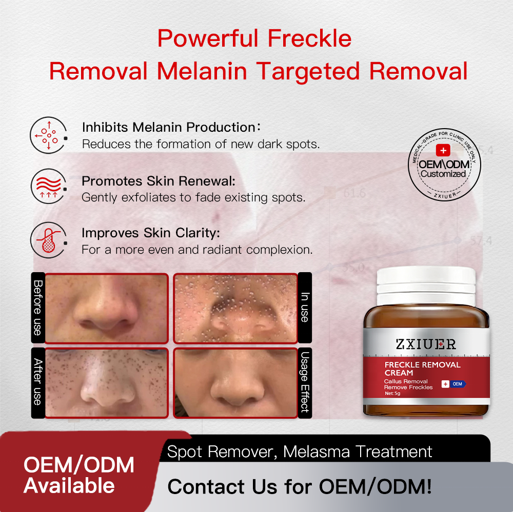 Professional Dark Spot Freckle Removal Cream Azelaic Acid Salicylic Acid Melasma Age Spots Hyperpigmentation Gentle Exfoliating