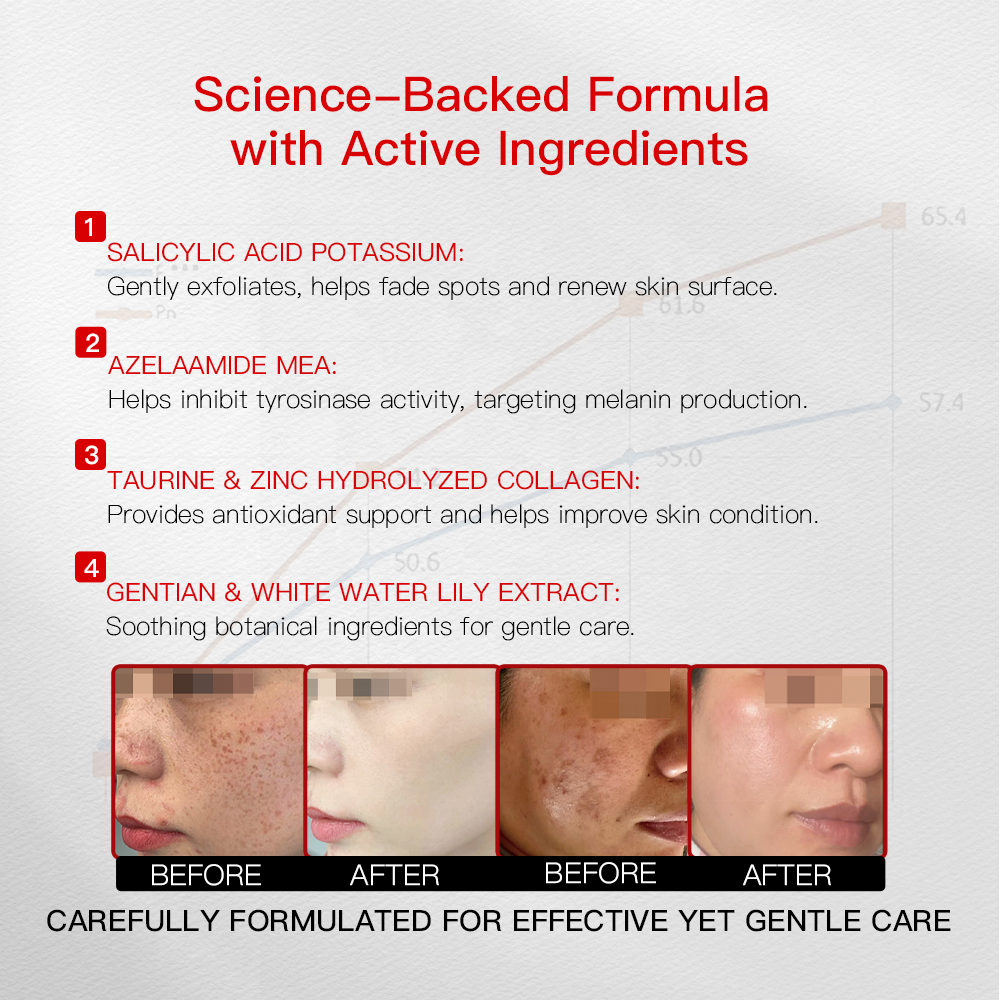 Professional Dark Spot Freckle Removal Cream Azelaic Acid Salicylic Acid Melasma Age Spots Hyperpigmentation Gentle Exfoliating