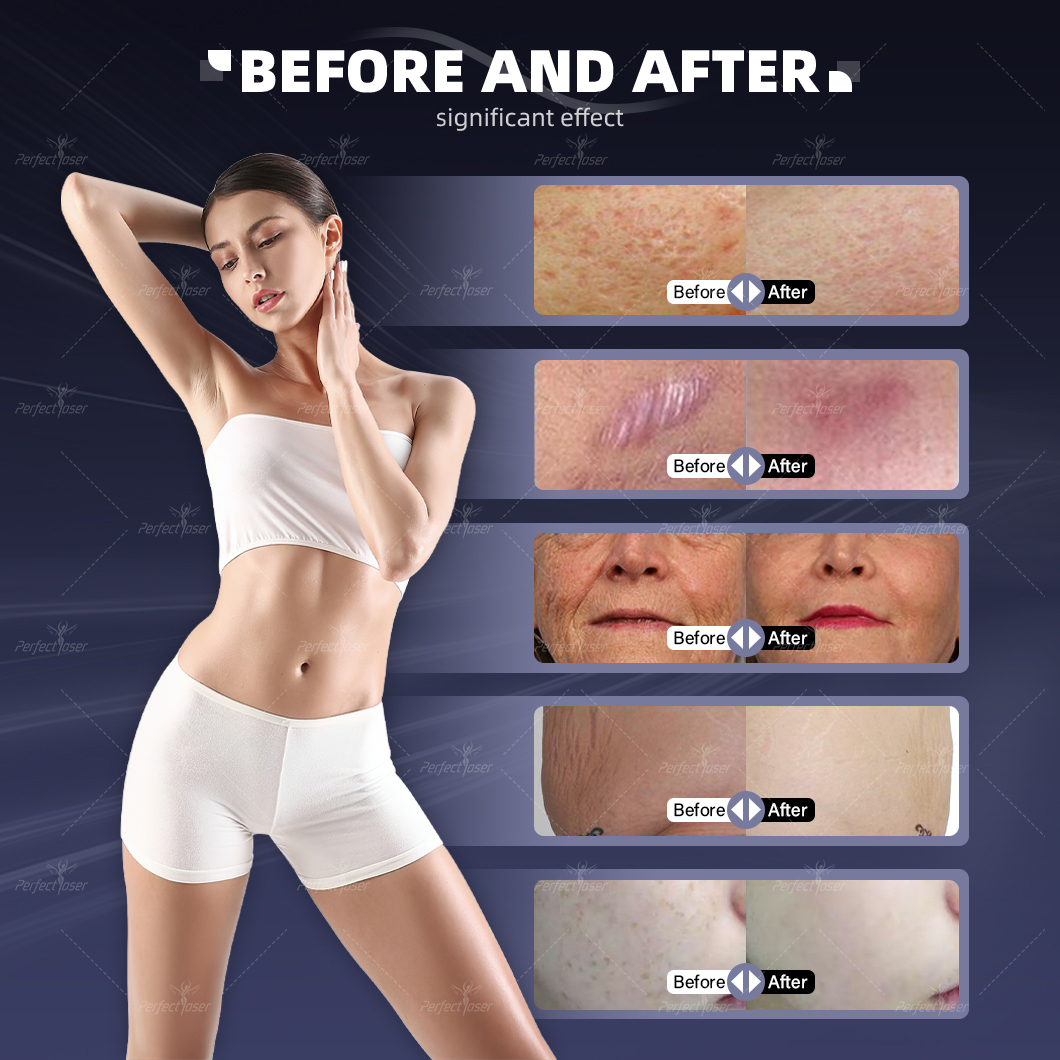 CO2 Fractional Laser Detail 5