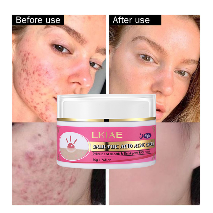 Private Label Face Anti Button Pore Minimizing Oil Control Anti Acne Pimples Remove Salicylic Acid Whitening Cream