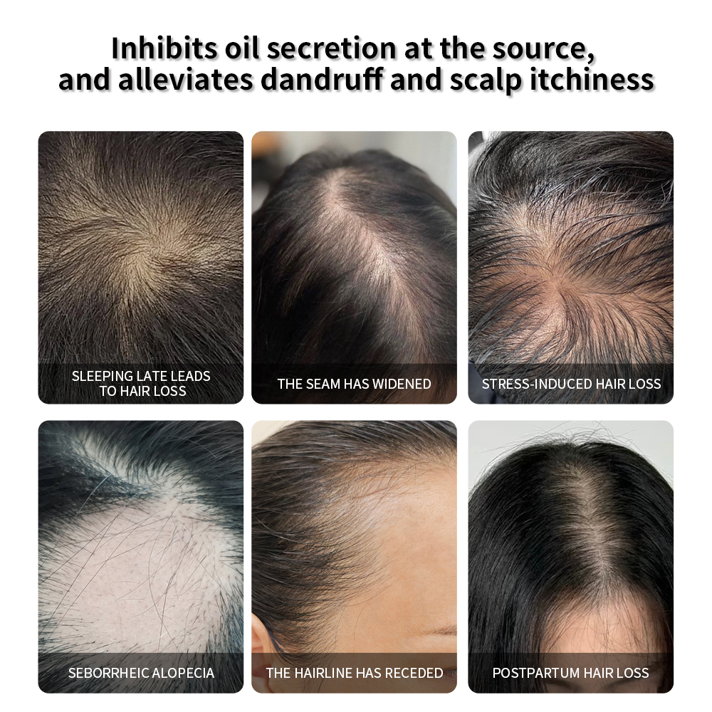 Scalp Essence Balance Sebum Oil Control Serum for Itchy and Flaky Scalp Treatment