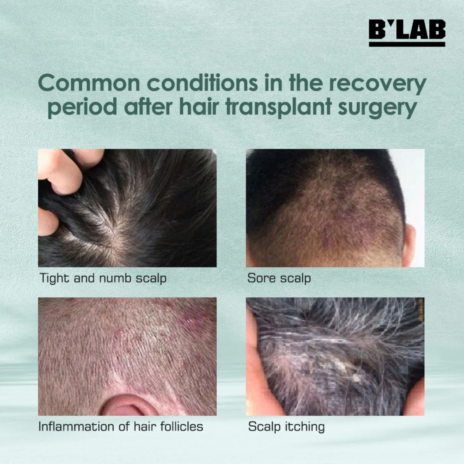 Transplant After Care Series Hair Tranplant Soothing Cleanser Private Label Scalp Care