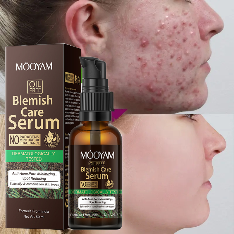 2023 Latest Skin Care OEM Acne Treatment Salicylic Acid Facial Efficient Acne Removal Solution