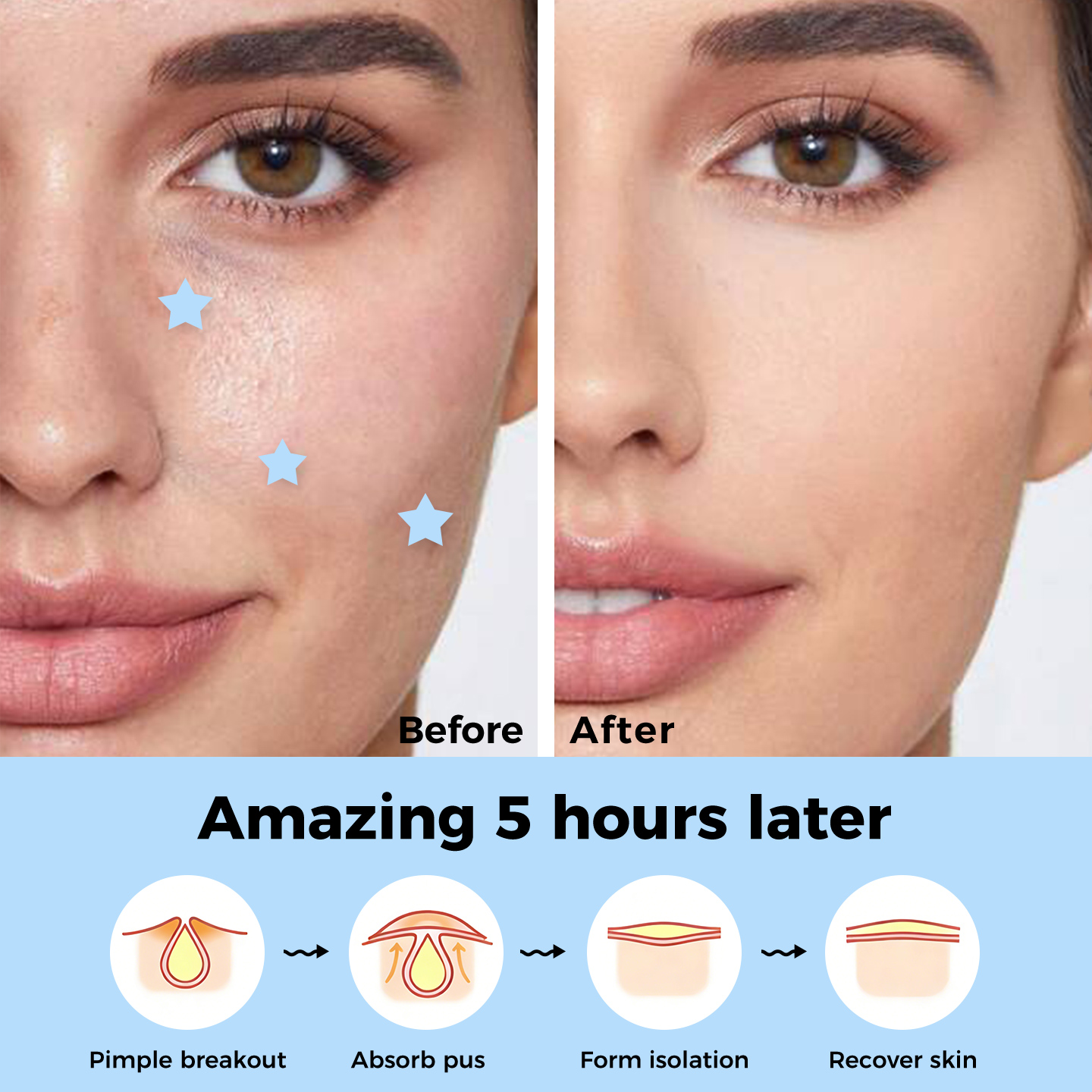 OEM/ODM Invisible Hydrocolloid Pimple Patch Waterproof Breathable Tea Tree Oil Acne Patch for Face Acne Treatment