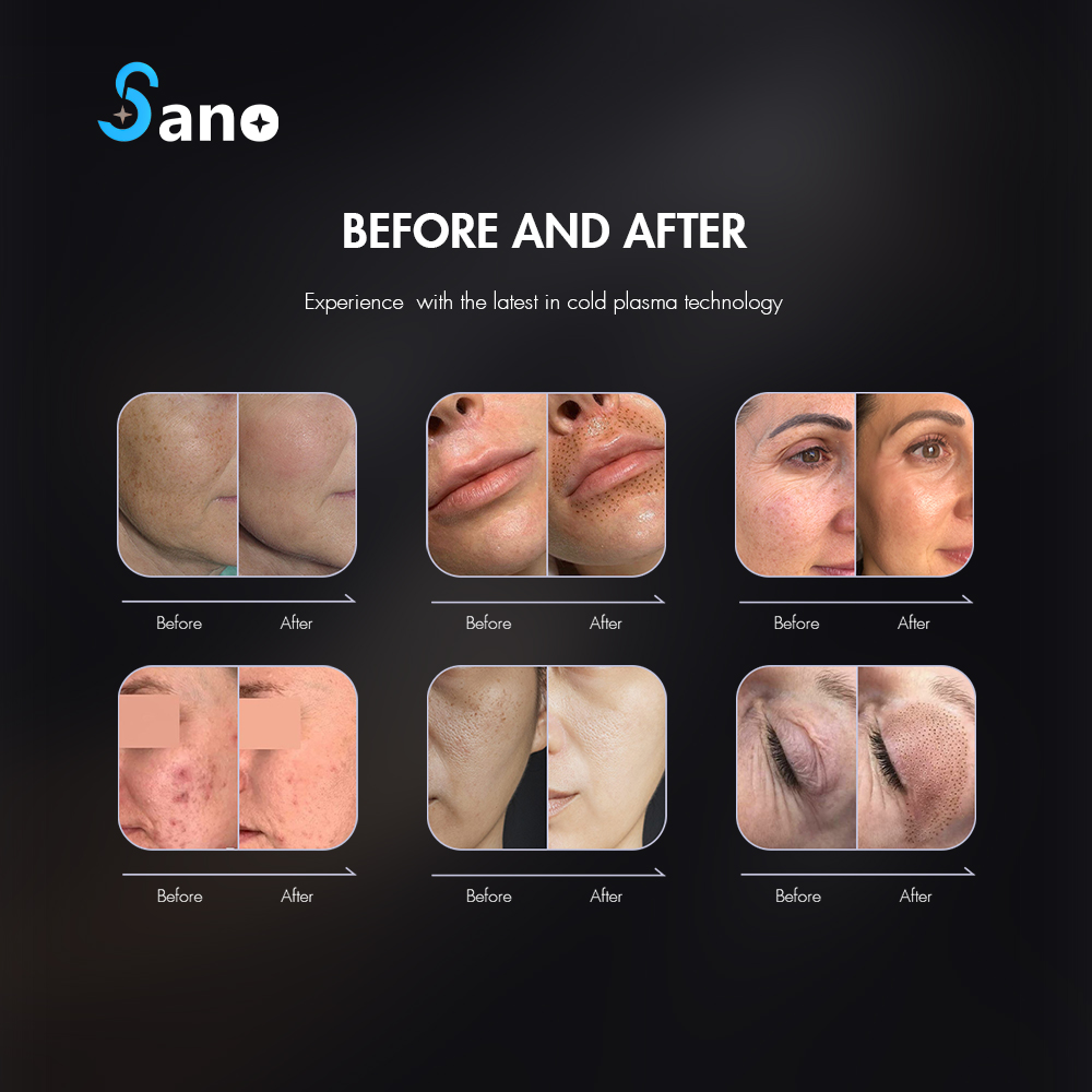 Skin Repair Anti Aging Face Machine Wrinkle Anti Aging Device Facial Machine Cold Plasma Beauty Machine