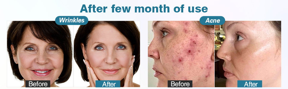 Derma Roller Kit 7
