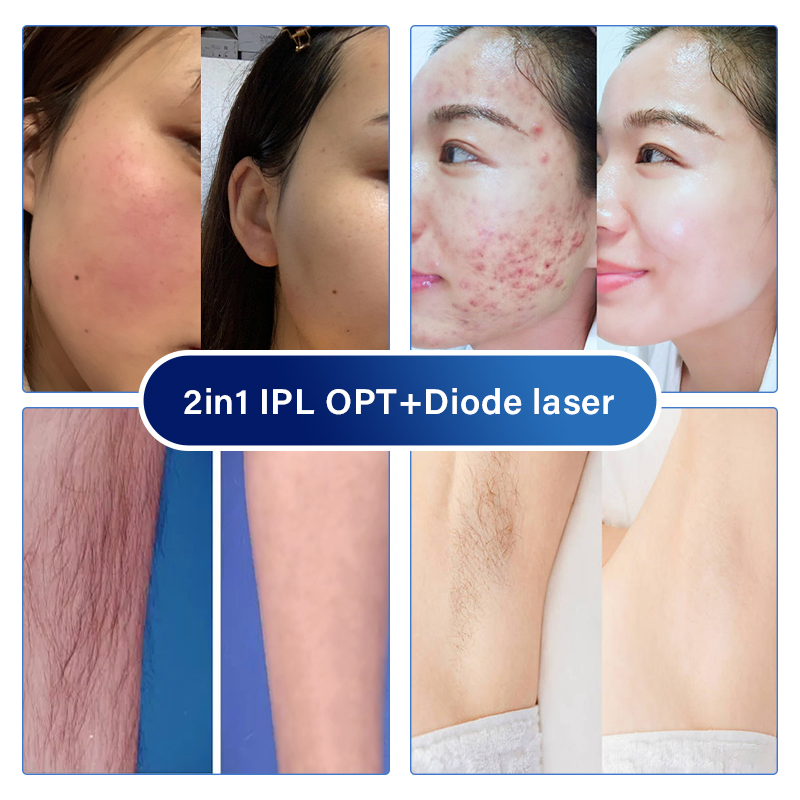 Multiple Wavelenths Skincare Pigmentation Treatment Laser Hair Remover