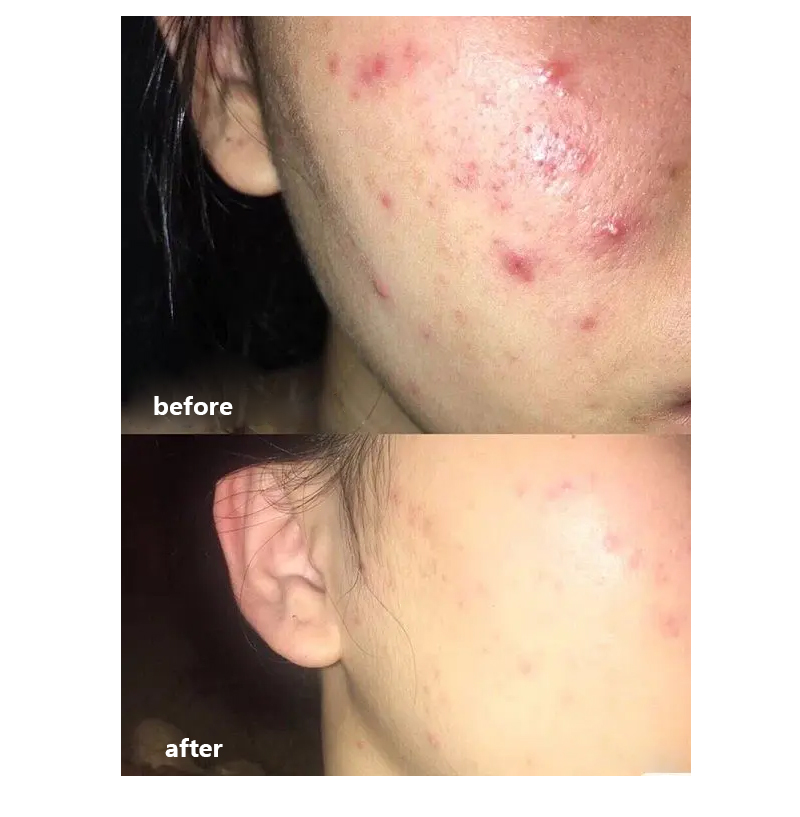 Acne Foaming Cream Cleanser Detail 3