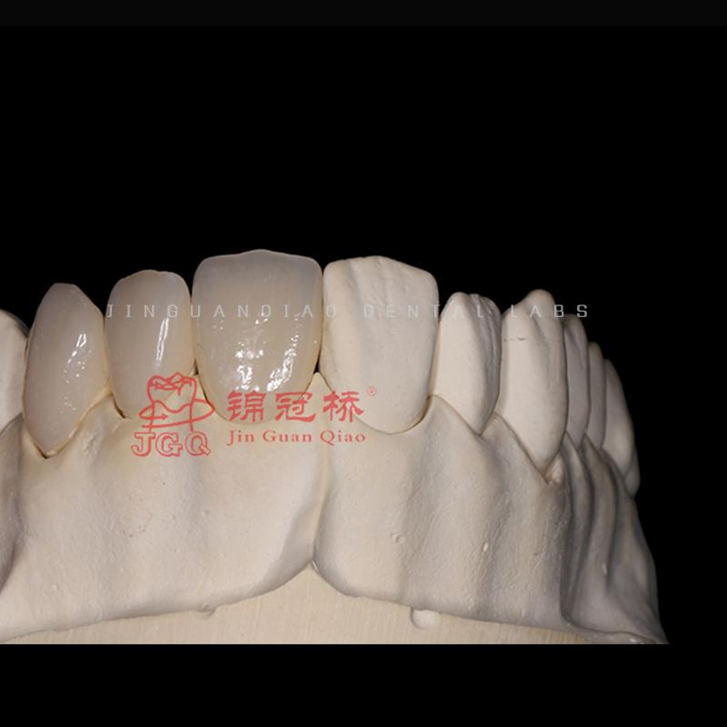 Customized Premium Emax Veneers with Natural Appearance for Visually Pleasing Dental Results
