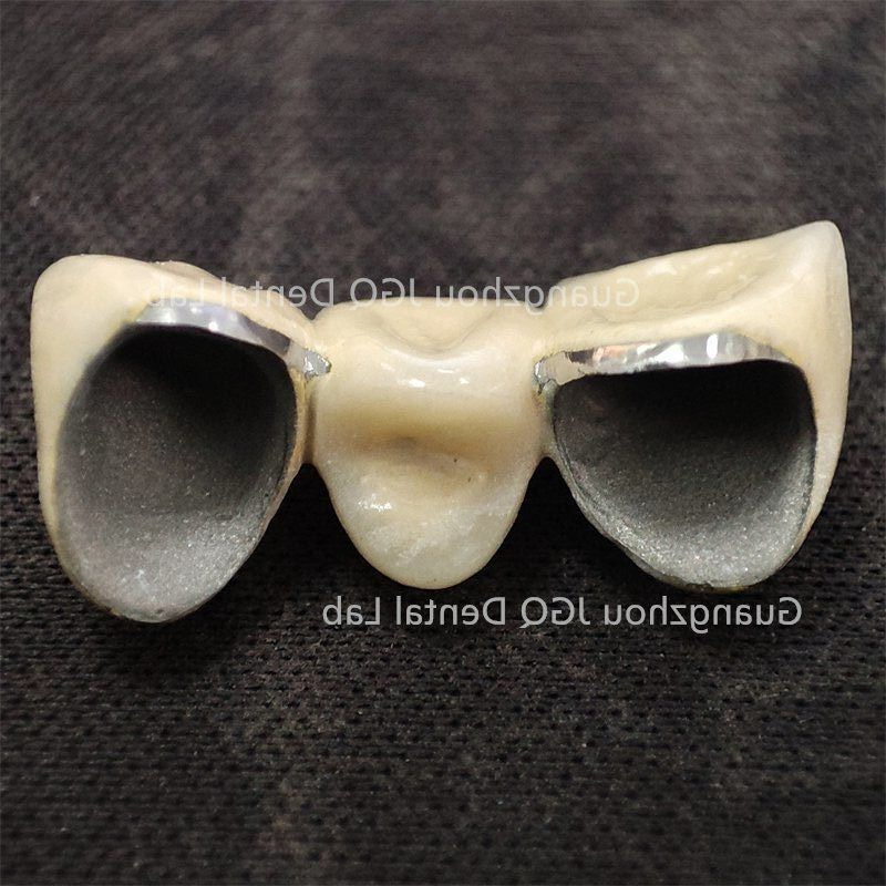 Pfm Single Crowns Short-Span Bridges Implant Supported Crown &amp; Bridge Perfect Fit