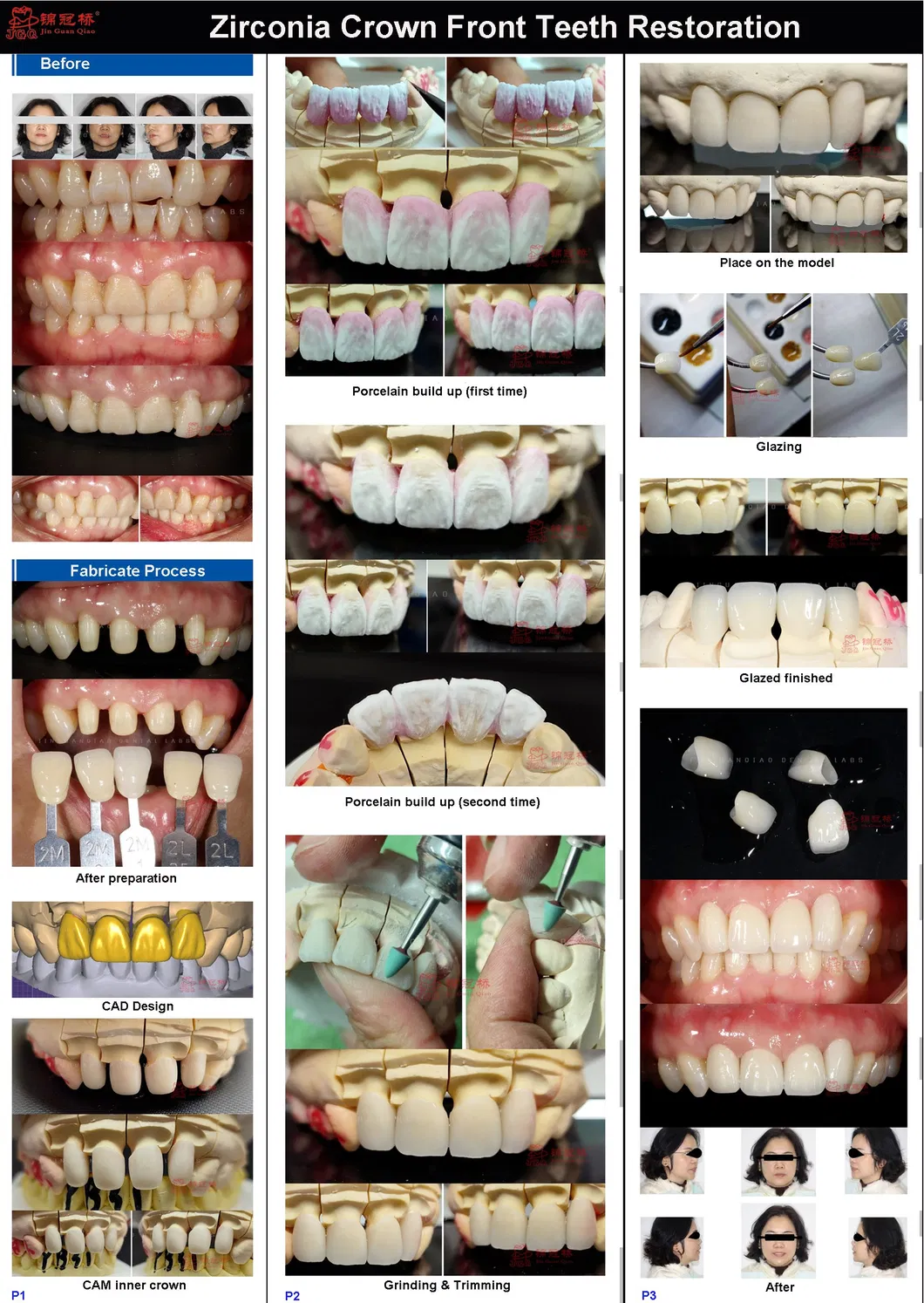 Detailed Dental Restoration