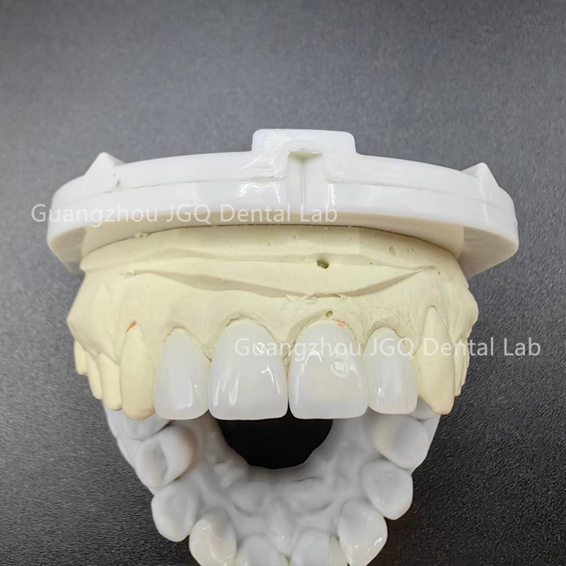 Customized Premium Emax Veneers with Natural Appearance for Visually Pleasing Dental Results