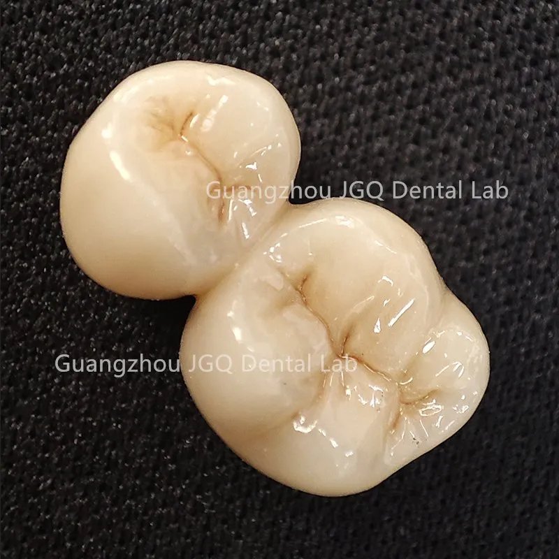Zirconia Crown Bridge Restoration
