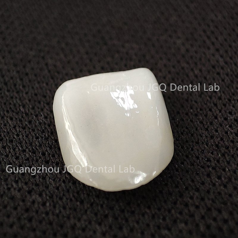 Customized Premium Emax Veneers with Natural Appearance for Visually Pleasing Dental Results