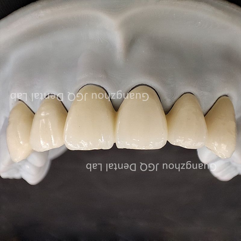 Outsourced Dental Lab Services Custom Zirconia Crown Bridge Anterior Posterior Restoration Best Price