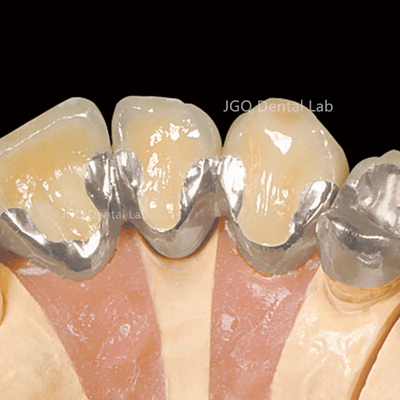 Metal Porcelain Crowns