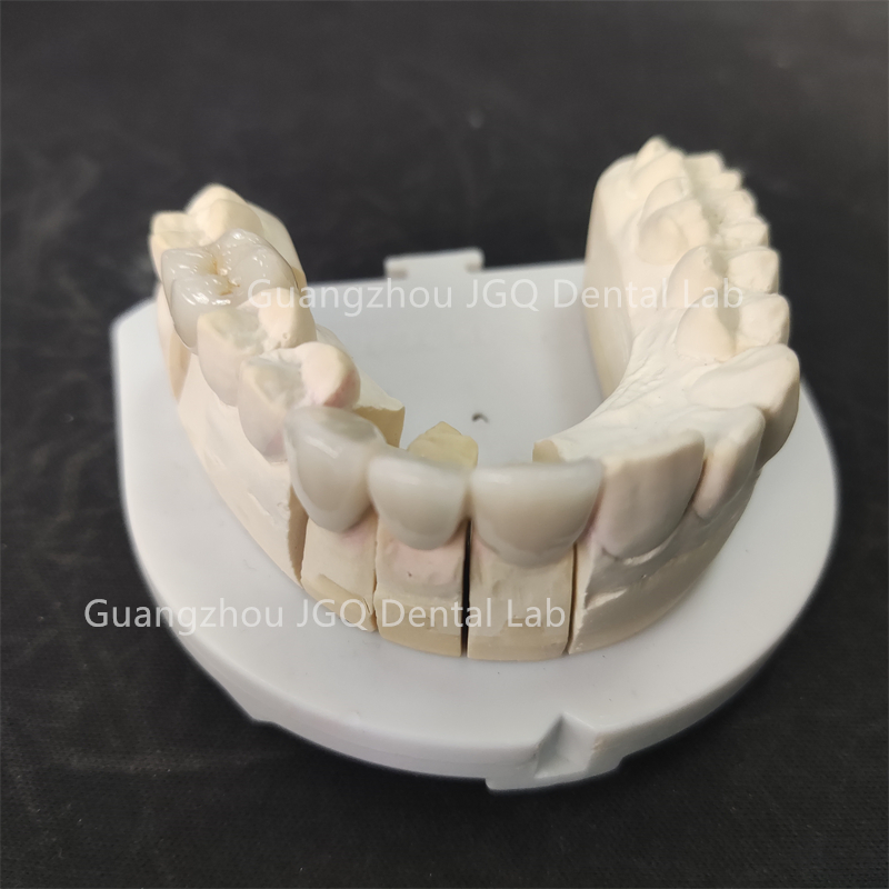 Digital Files Stl Outsoucing Dental Lab Metal Ceramic Pfm Crown Bridges China Price