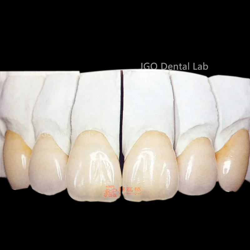 Zirconia Restoration