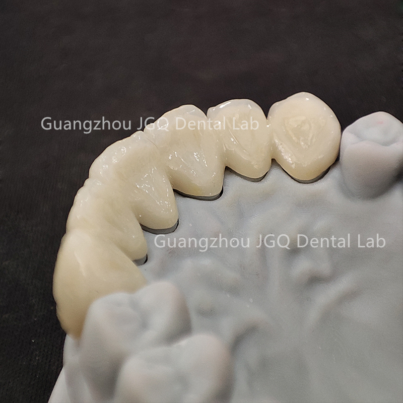Outsourced Dental Lab Services Custom Zirconia Crown Bridge Anterior Posterior Restoration Best Price