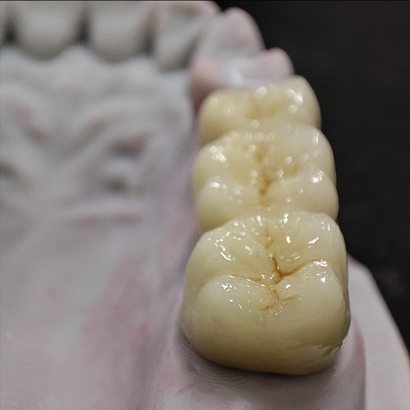 Digital Dental China Custom Full Solid Zirconia Bridge Crown Anterior Posterior Restoration Outsourcing Lab