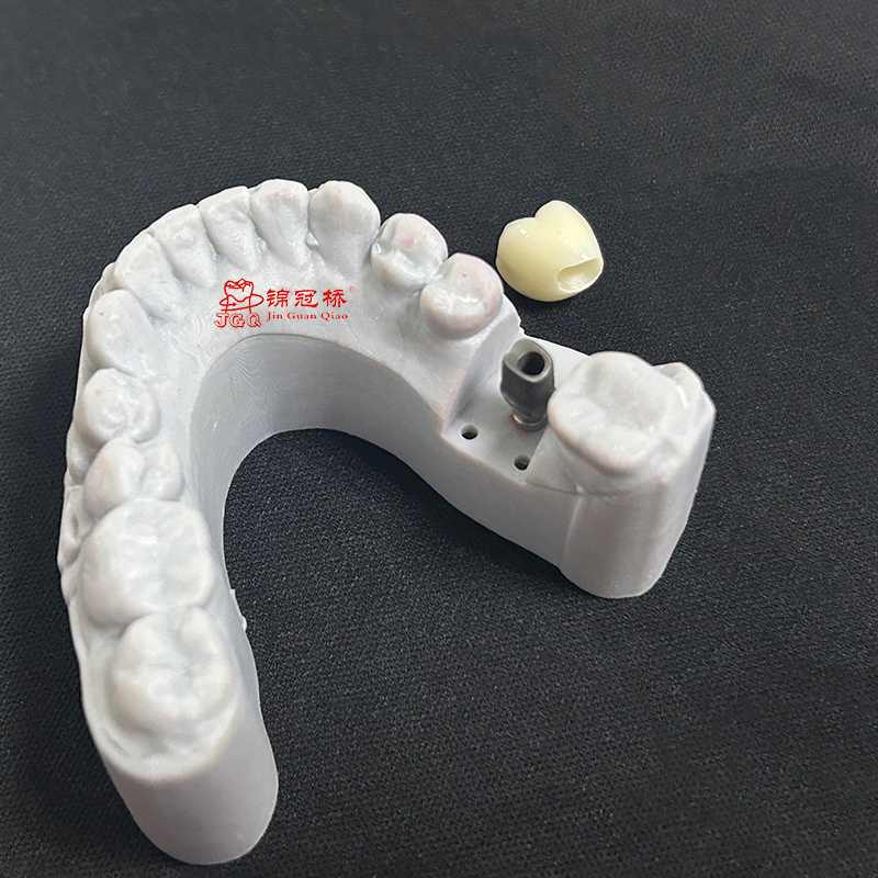 Implanted Dentures Manufacturer Custom Titanium Abutments Precise Adaptation Implants Aesthetically Pleasing Strong and Durable