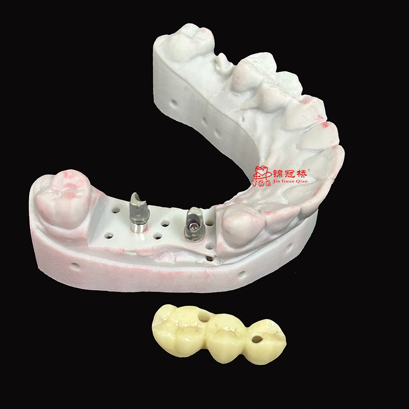 Implanted Dentures Manufacturer Custom Titanium Abutments Precise Adaptation Implants Aesthetically Pleasing Strong and Durable