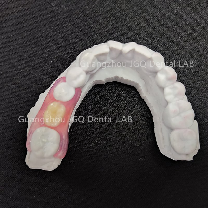 Custom Affordable Clear Pink Removable Partial Valplast Dentures with Flexible Base Acrylic Teeth