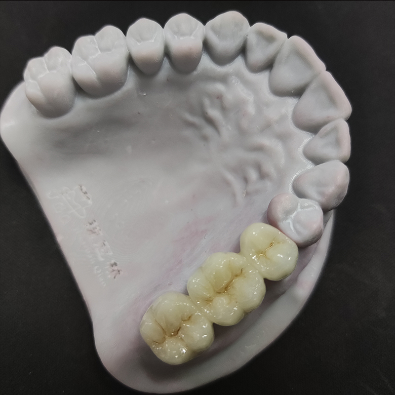 Digital Dental China Custom Full Solid Zirconia Bridge Crown Anterior Posterior Restoration Outsourcing Lab