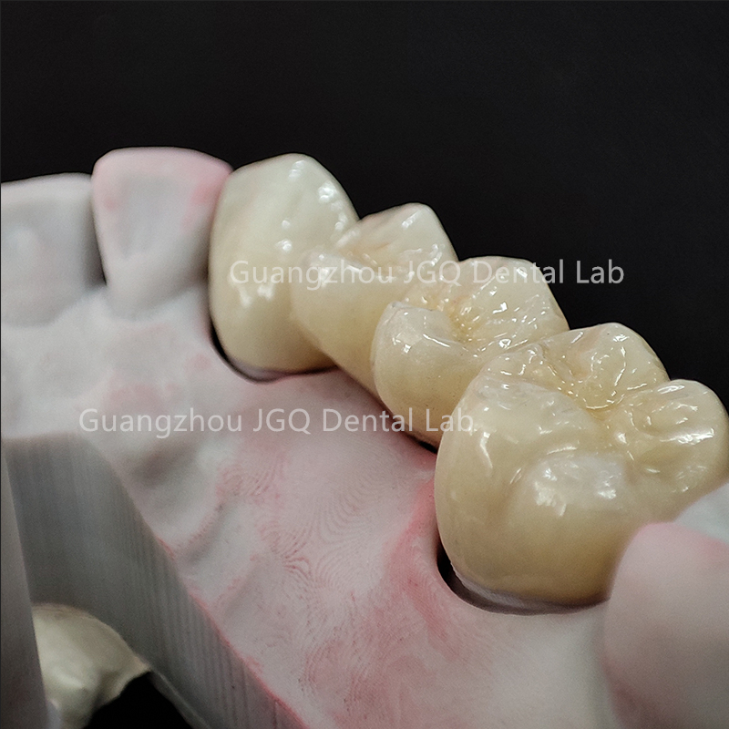 High Quality Perfect Perfect Aesthetic Zirconia Dentures Crown and Bridges with Cheap Price