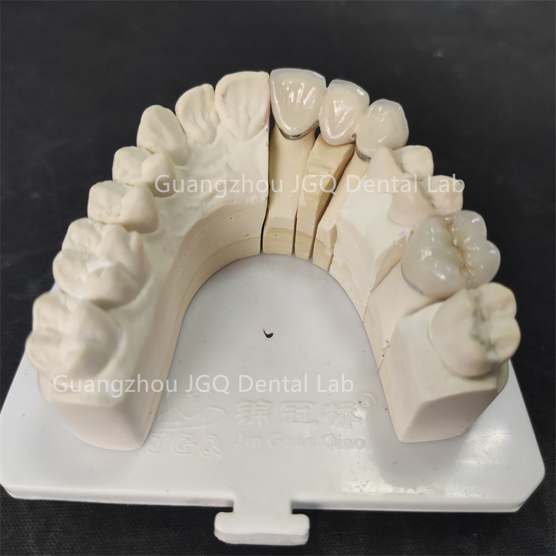 Digital Files Stl Outsoucing Dental Lab Metal Ceramic Pfm Crown Bridges China Price