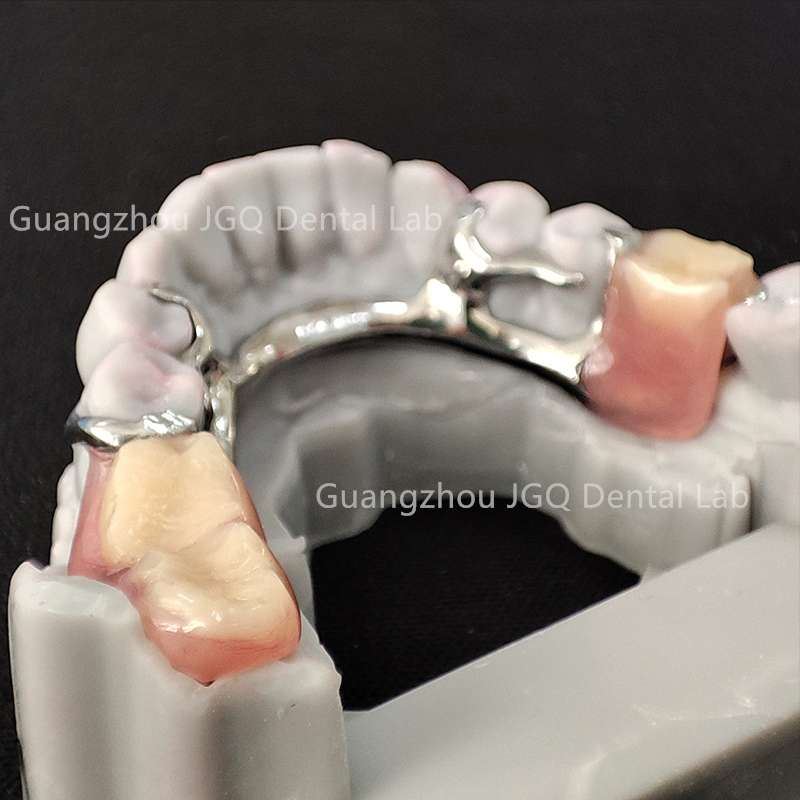 Removable Dentures Manufacturer Customize Partial Metal Frame with Acrylic Teeth Flexible