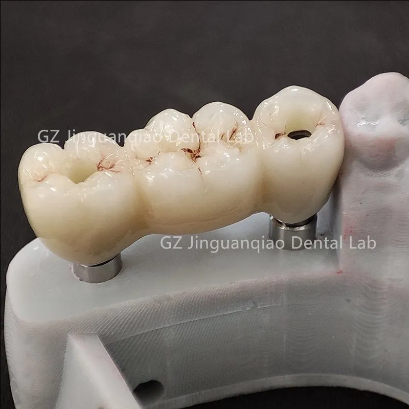 Implant Denture