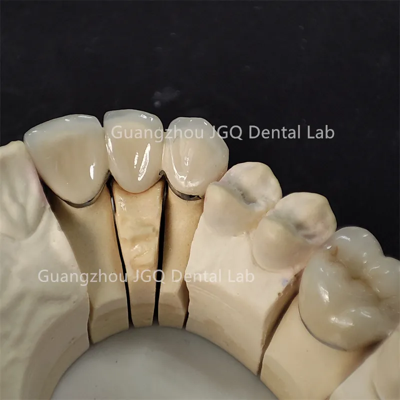 Dental PFM Crown