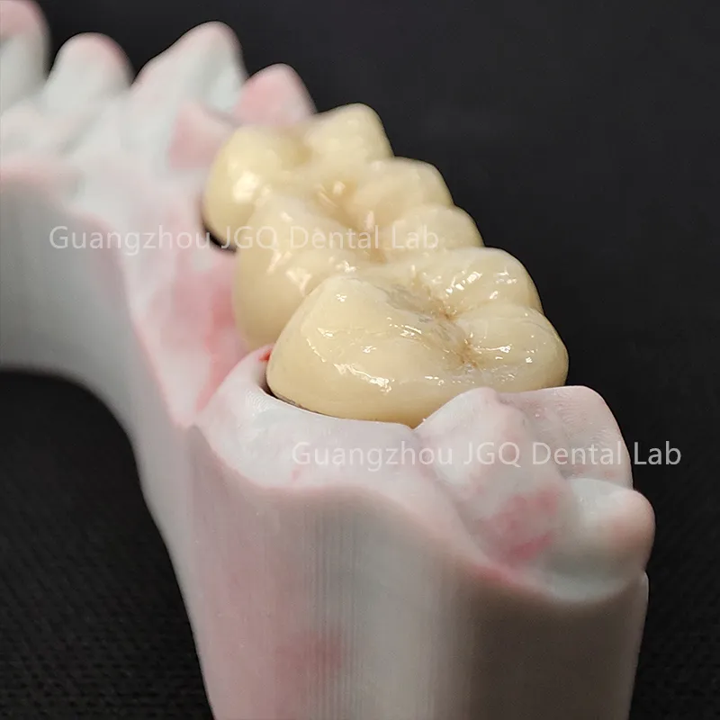 Zirconia Crown
