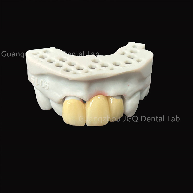 Pfm Single Crowns Short-Span Bridges Implant Supported Crown &amp; Bridge Perfect Fit
