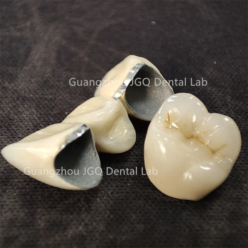 Pfm Single Crowns
