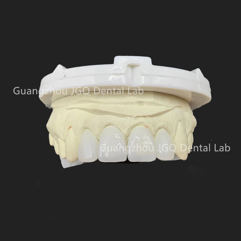 Customized Premium Emax Veneers with Natural Appearance for Visually Pleasing Dental Results