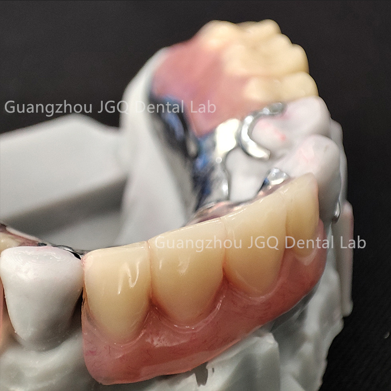Removable Dentures Manufacturer Customize Partial Metal Frame with Acrylic Teeth Flexible
