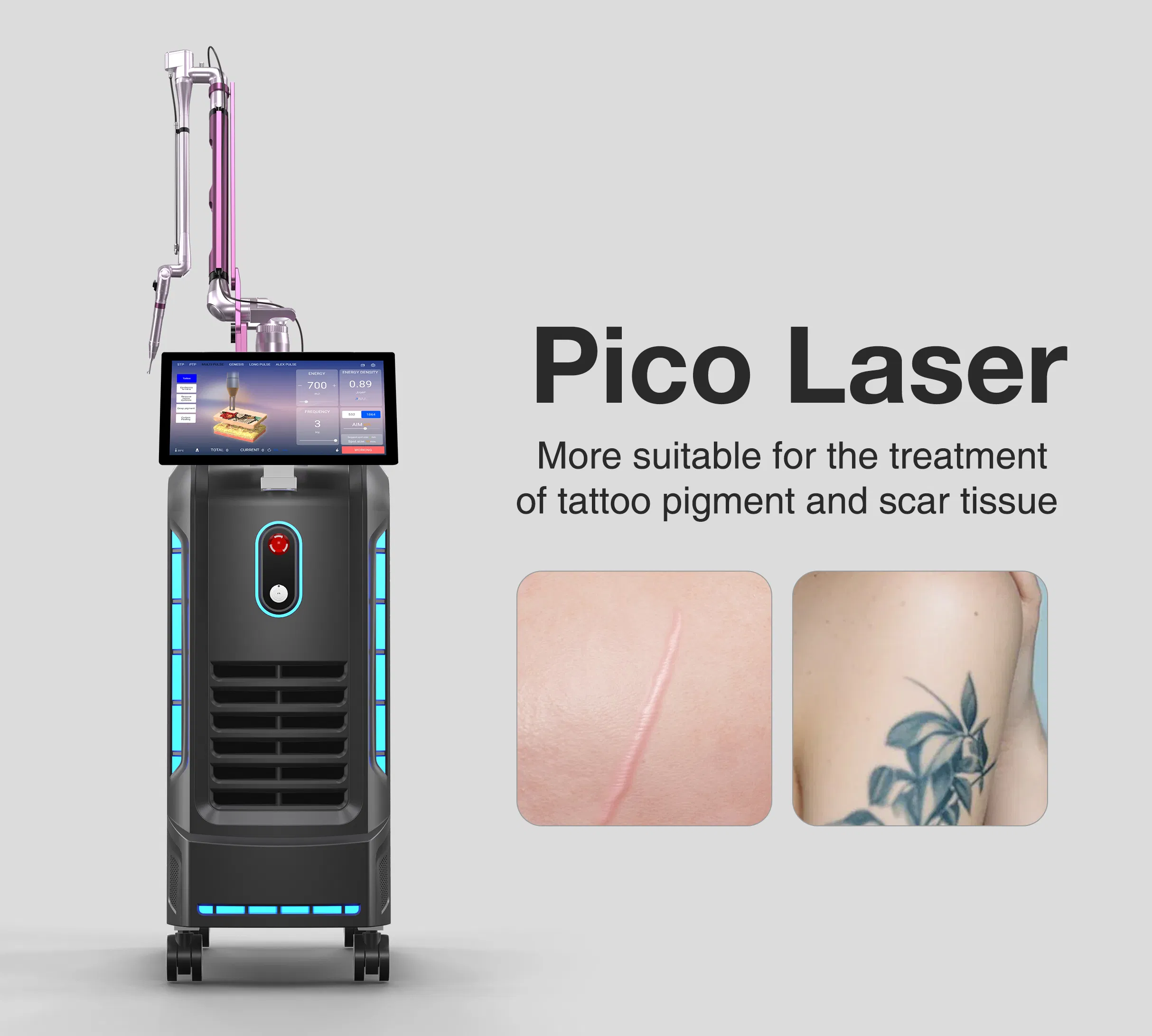 Powerful Tattoo Removal System Using Q-Switched ND YAG Laser